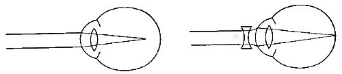 FIG. 81.—The nearsighted eye. The defect is remedied
by concave glasses.