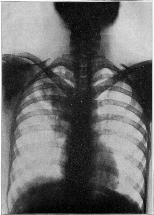 Fig. 16. X ray Showing Tuberculosis of the Lung.