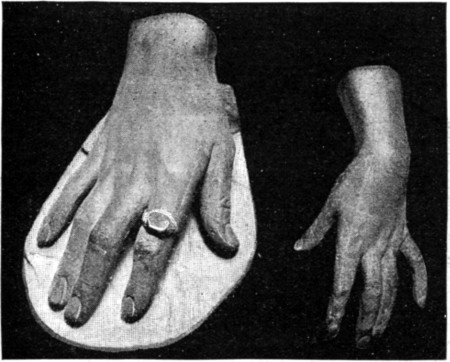 HAND OF ANAK, THE GIANT. HAND OF CAROLINE, SISTER OF
NAPOLEON.