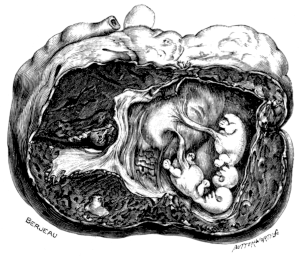 A Gravid Fallopian Tube