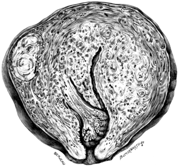 An Adenomyomatous Uterus
