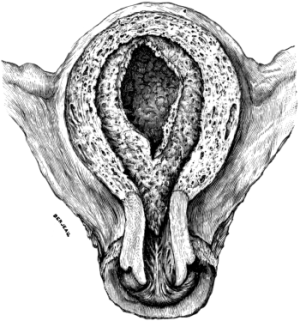 Uterus with the Decidua in Situ