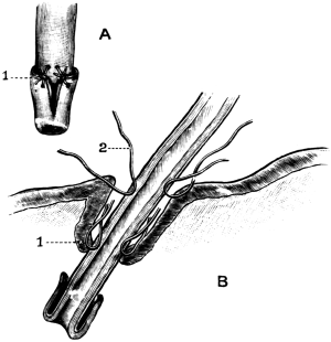 The Relation of Parts after
Ricard’s Operation of Uretero-cysto-neostomy