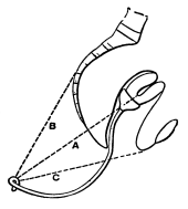 Chronic Uterine Inversion