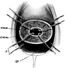 Hegar’s Operation
for Supravaginal Elongation of Cervix