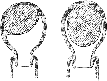 Submucous Fibro-myomata, capable of Treatment by Morcellement