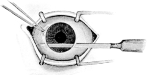 Making the Counter-puncture in Cataract Extraction