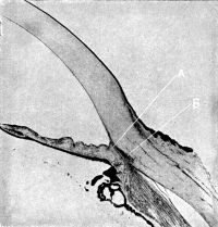 The Angle of the Anterior Chamber
from a Case of Recent Glaucoma