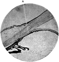 The Angle of the Chamber in
a case of Chronic Glaucoma