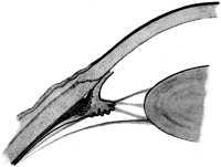 Iridectomy for Glaucoma