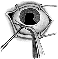 Iridectomy for Glaucoma
