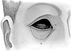 Maxwell’s Operation for Contracted Socket