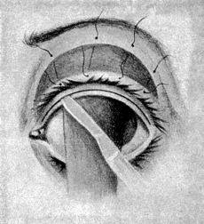 Arlt’s Operation for Trichiasis