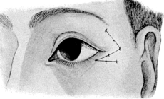 Denonvillier’s Operation for Ectropion