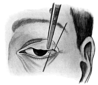 Excision of the Palpebral Portion of the Lachrymal Gland