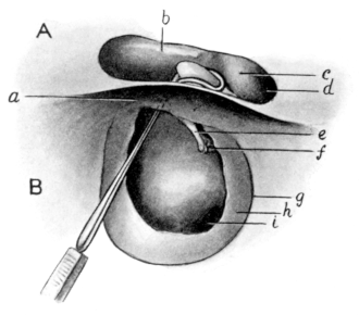 Removal of Incus by Zeroni’s Hook