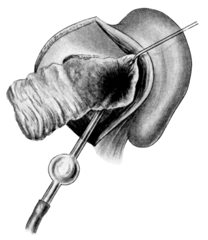 Skin-grafting of Mastoid Wound Cavity after Operation