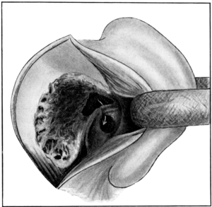 Extirpation of the Labyrinth