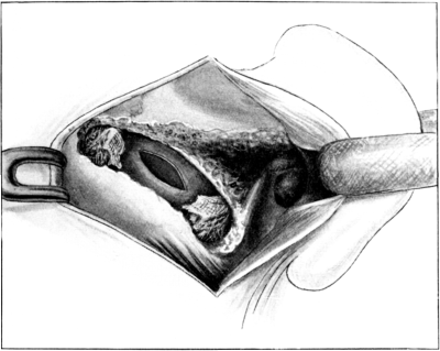 The Lateral Sinus exposed and opened