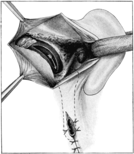 Free Exposure of the Lateral Sinus, which has been incised, with Ligature of the Internal Jugular Vein