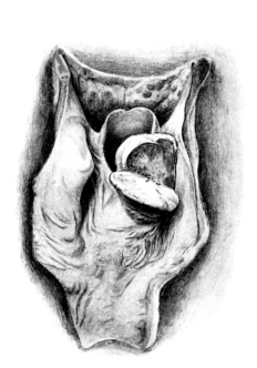 Extrinsic Tumour of the Larynx