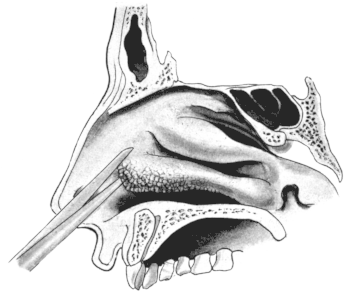 First Step in removing the Anterior End of the Inferior Turbinal,
which is seen to have undergone Polypoid Degeneration