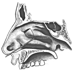 Second Step in the Removal of the Anterior End of the Middle Turbinal