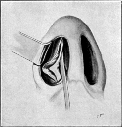 Denudation of the Septum in Submucous Resection