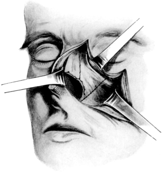 The Area of Bone removed in Lateral Rhinotomy