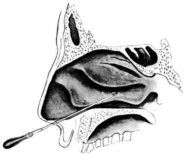 Puncturing the Maxillary Sinus