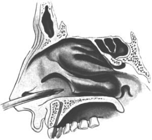 Opening the Maxillary Sinus from the Nose