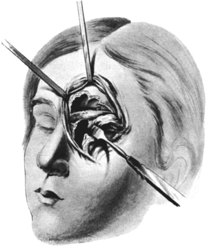 Killian’s Operation upon the Frontal Sinus