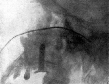 Radiograph showing a Probe in the Sphenoidal Sinus