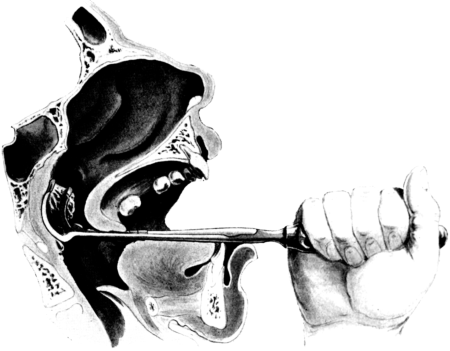 Removal of Naso-pharyngeal Adenoids